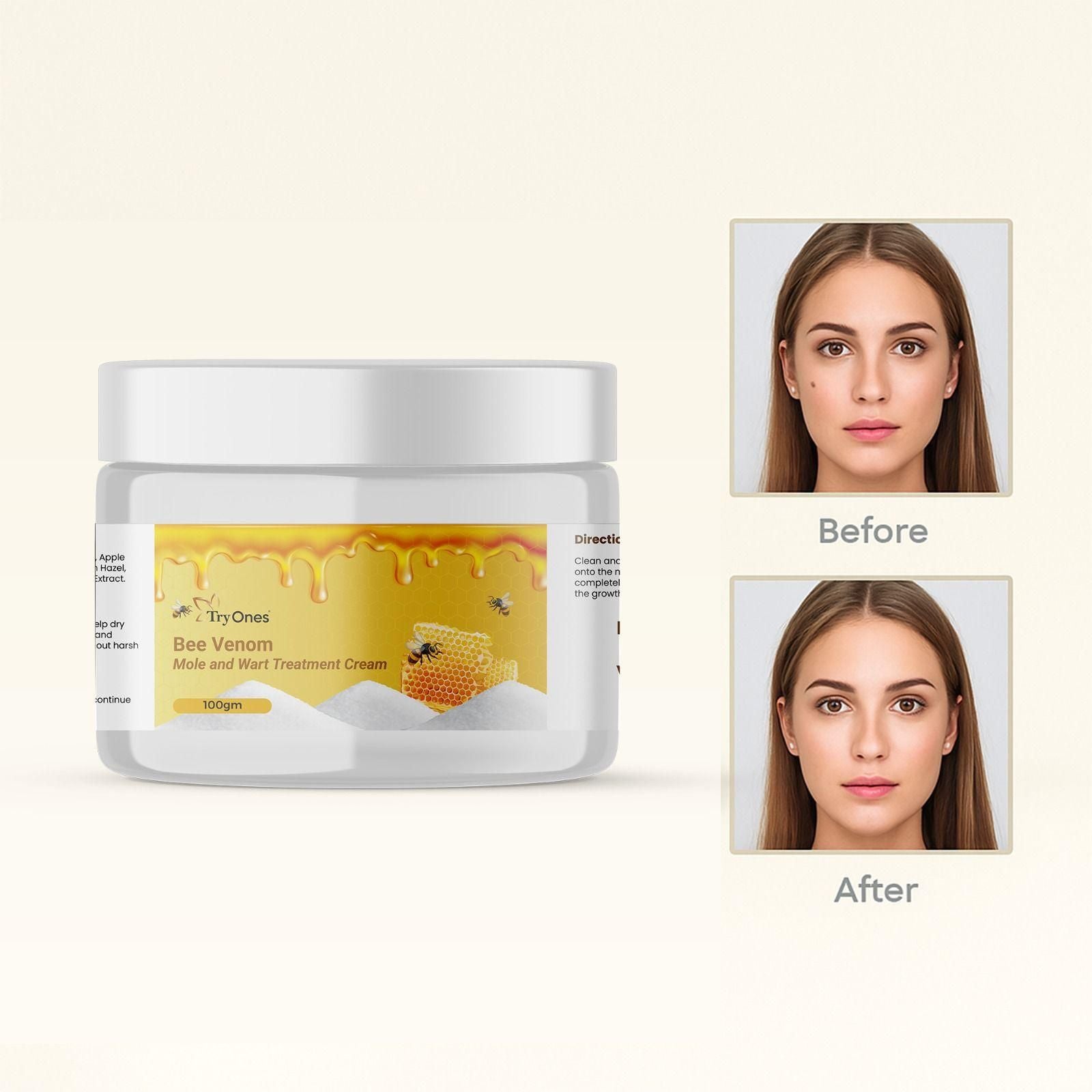 Bee Venom Mole and Wart Treatment Cream 100 gm Pack of 1